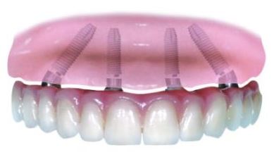 all-on-4 dental implants bridge