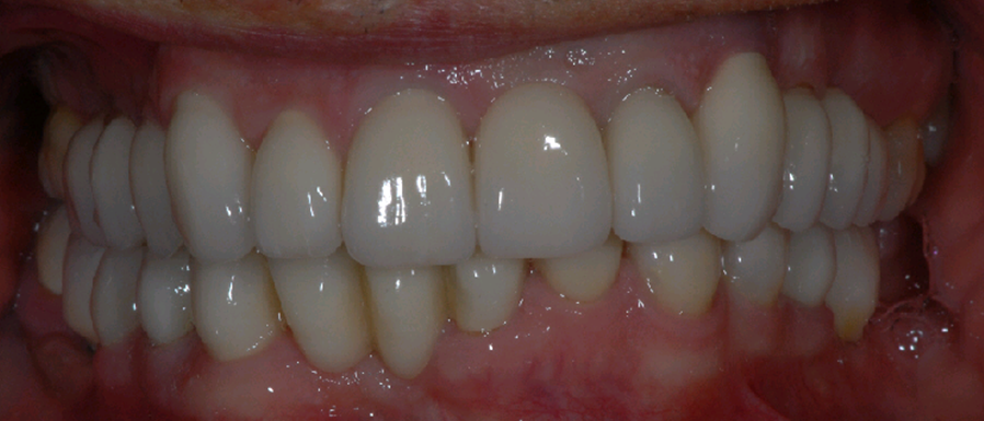 Haghill Glasgow patient after dental implants treatment