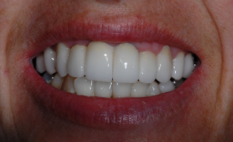 Baillieston Glasgow client after teeth whitening