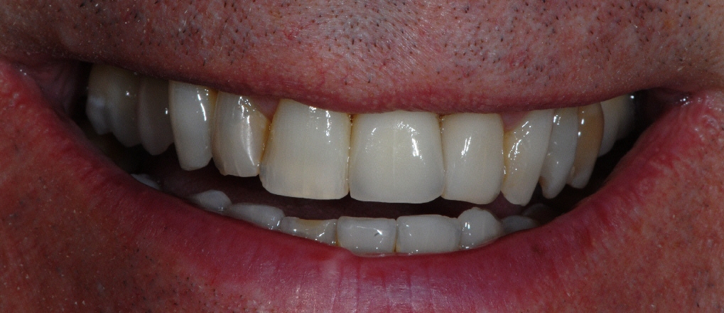 Newton Mearns Glasgow client after dental implants treatment